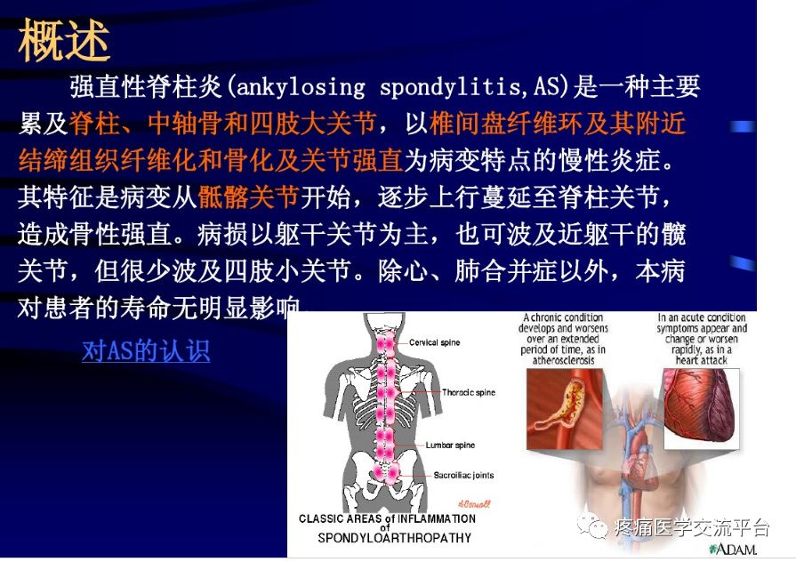 强直性脊柱炎最新疗法,强直性脊柱炎最新疗法，突破传统，走向新生